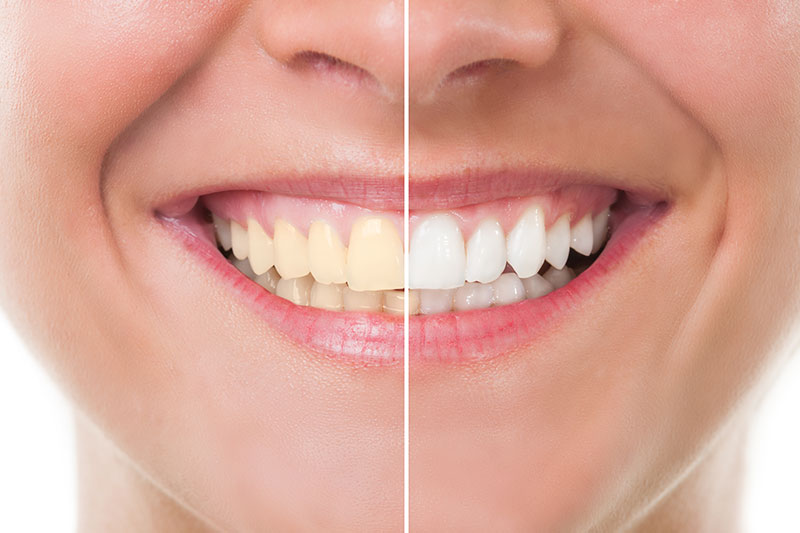 Teeth Whitening in Mountain View